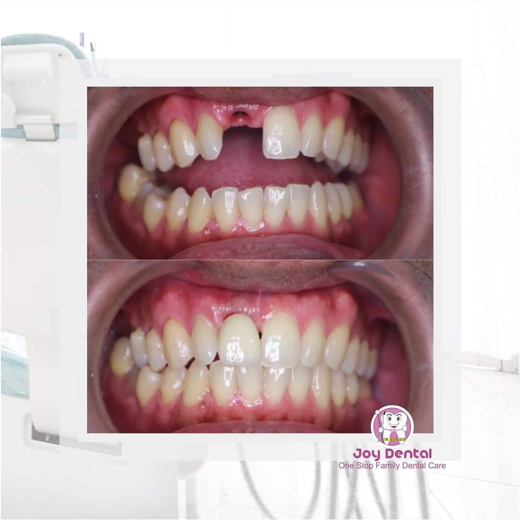 Arti Mimpi Gigi Dicabut Orang Lain menurut Agama, Psikologi dan Primbon